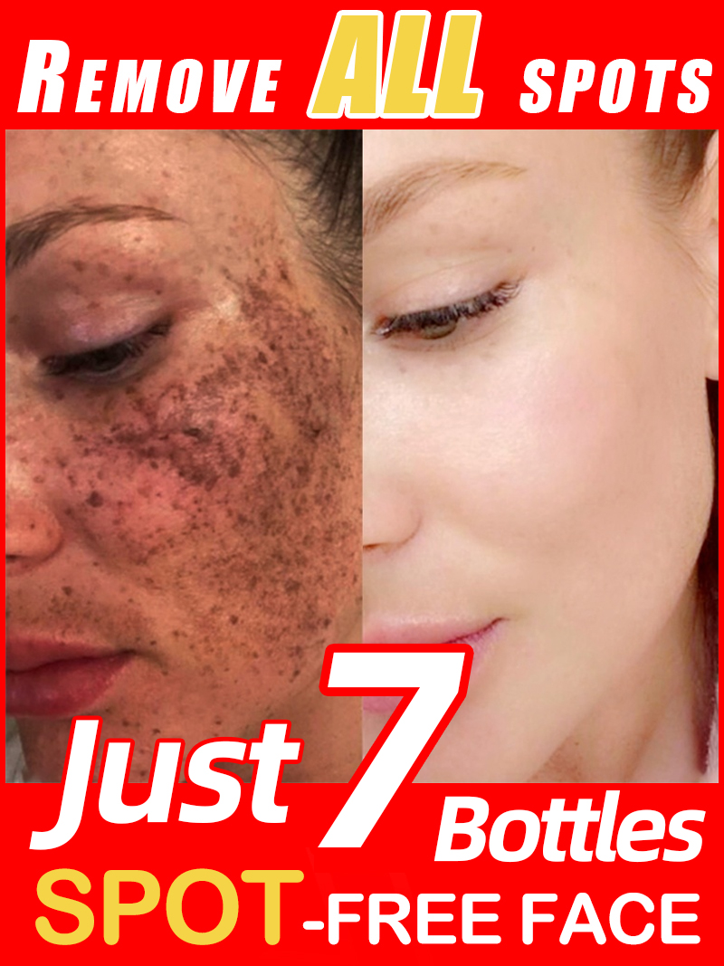 Lighten Freckles Melasma, Faci - огляд і ціна Luxury Skincare Essence